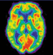 Positron Emission Tomography Image of Brain