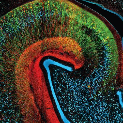 Two different markers for dying neurons (green and red) can be seen accumulating phospho-tau, in contrast to healthy neurons (blue), in a monkey model of Alzheimer's disease.